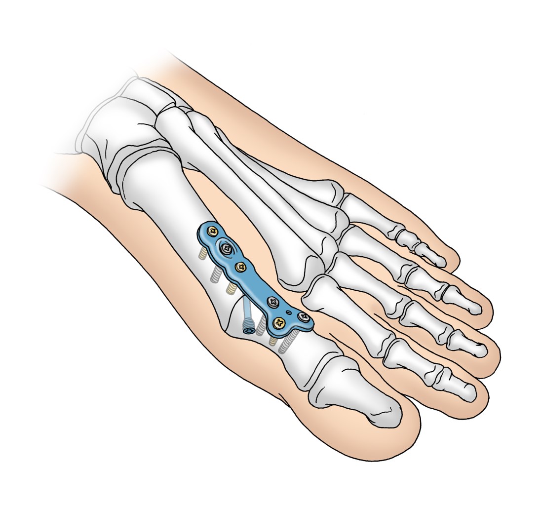 Hallux Rigidus